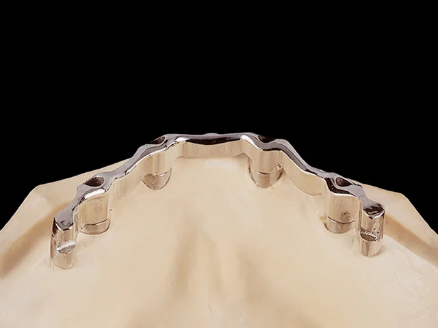 Coverdenture auf Implantatsteg