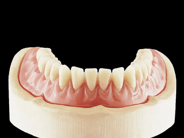 Coverdenture auf Kugelkopfverankerung