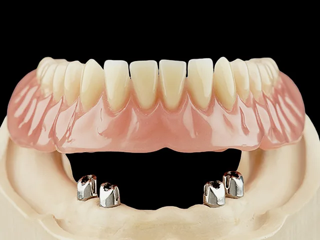 Coverdenture Teleskopkronen auf Implantaten