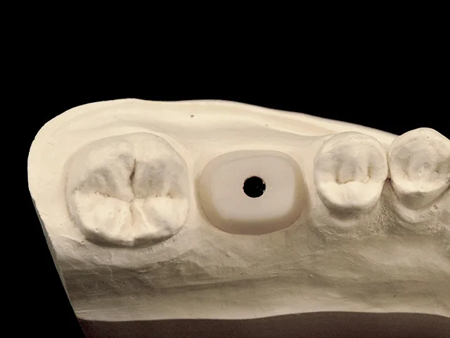 Individuelles Abutment