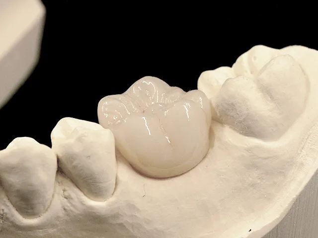 Individuelles Abutment