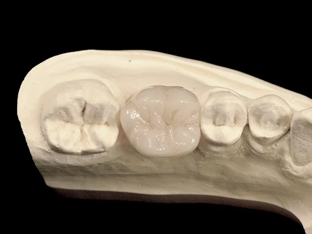 Individuelles Abutment