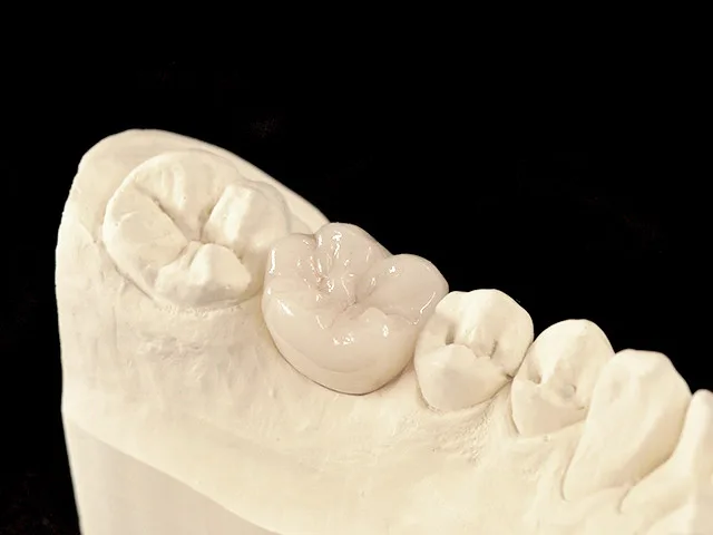 Individuelles Abutment