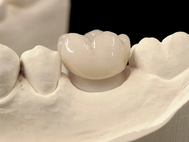 Individuelles Abutment